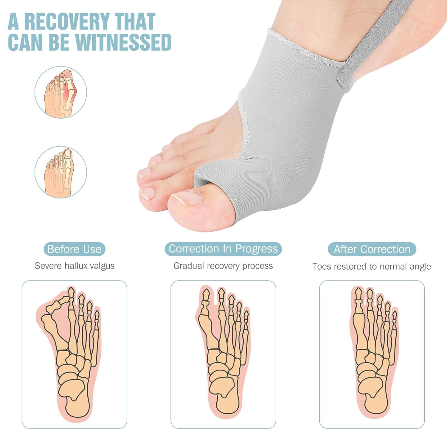 Toe Corrector Bunion Splint 2 Pack Adjustable Separator Support Brace Gray Foot
