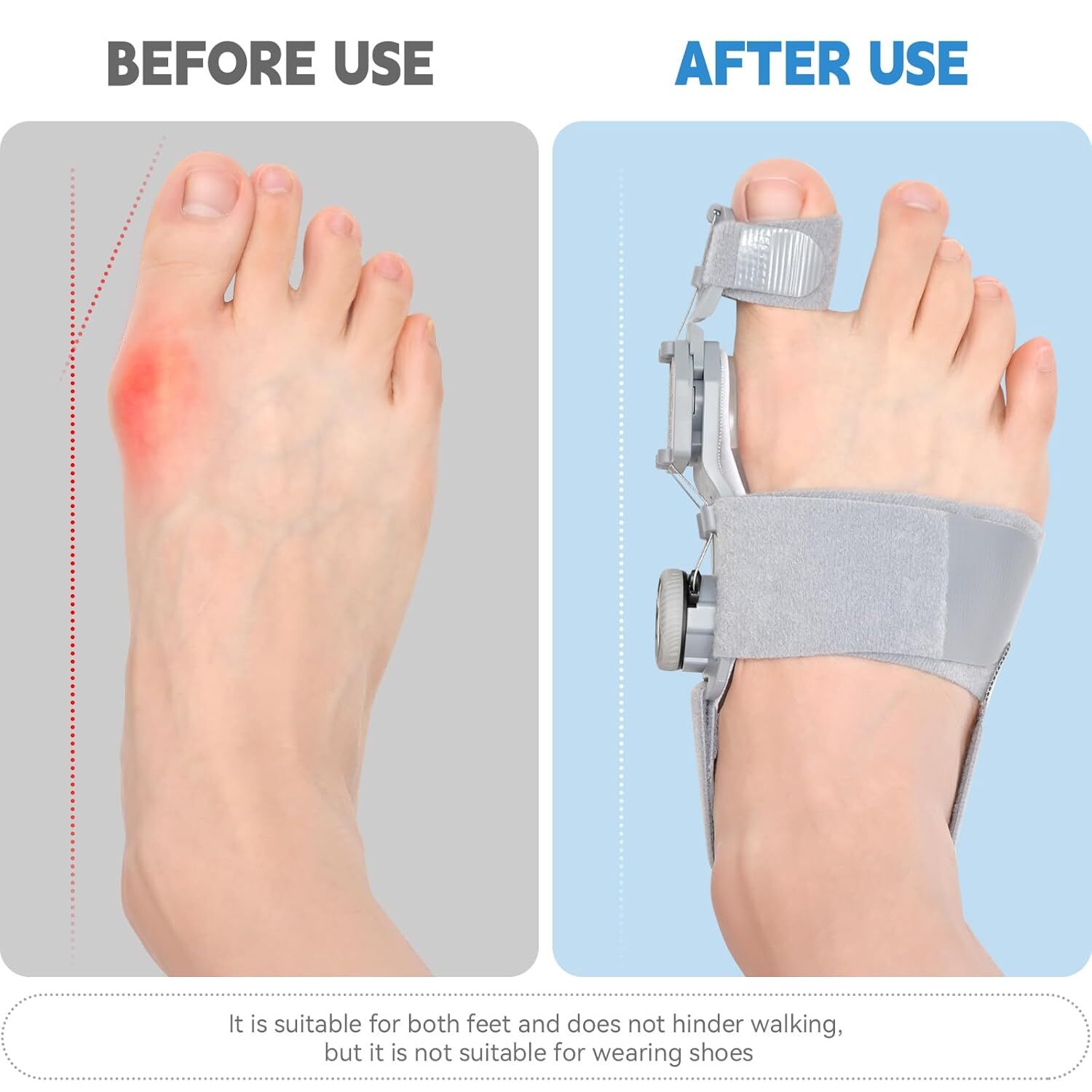 Hallux Valgus Bunion Corrector Splints Straightener Big Toe Foot for Pain Relief