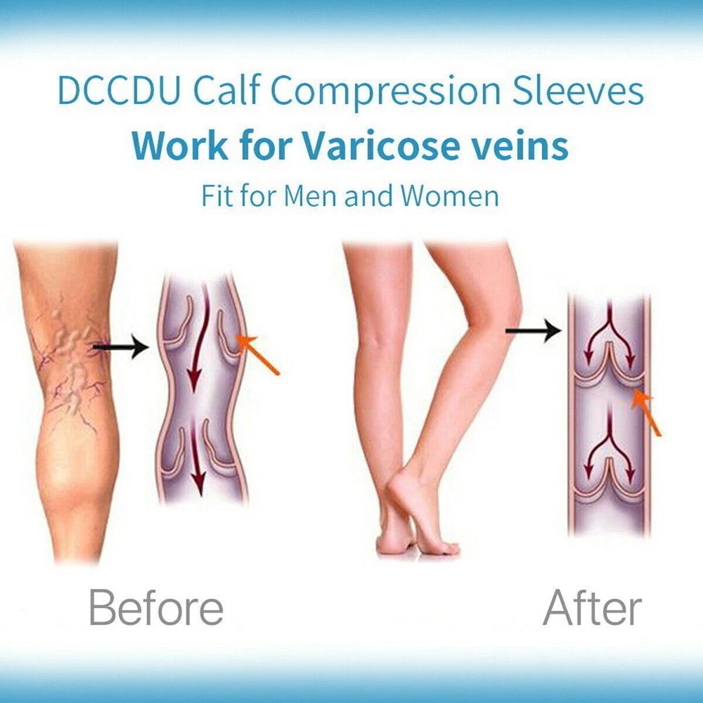 Zipper Open Toe Compression Socks 20-30mmHg Calf Leg Ankle Support Stocking