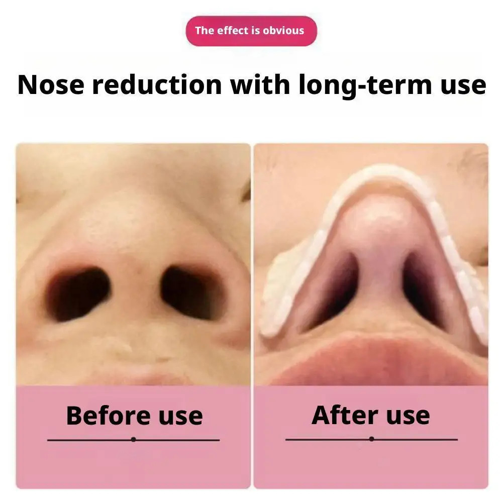 1/2 Packs Thermoplastic Nasal Splints,Trapezoid Nose Brace Splints Nose External