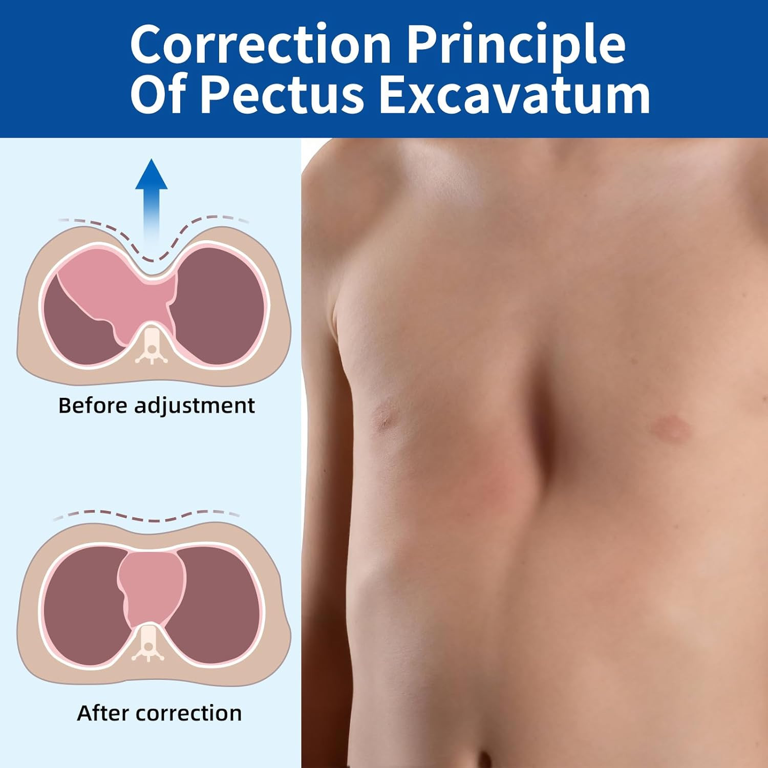 Pectus Excavatum Vacuum Bell with Automatic Pump Pectus Excavatum Orthosis Brace