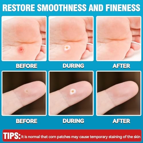 AstraVox 24Pcs Corn Removers for Toes Feet with Adhesive PU Waterproof Large