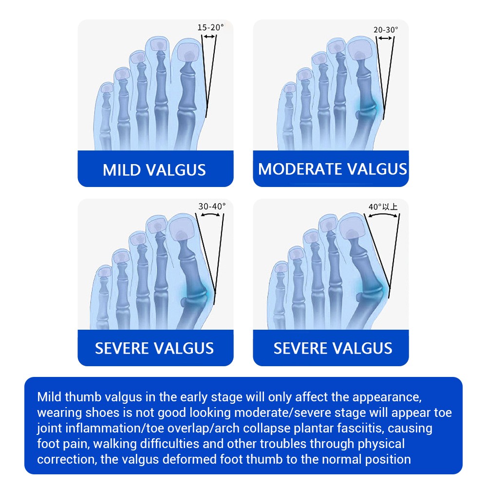 Adjustable Toe Splint Bunion Corrector Big Toe Valgus Correct Tool for Feet Care