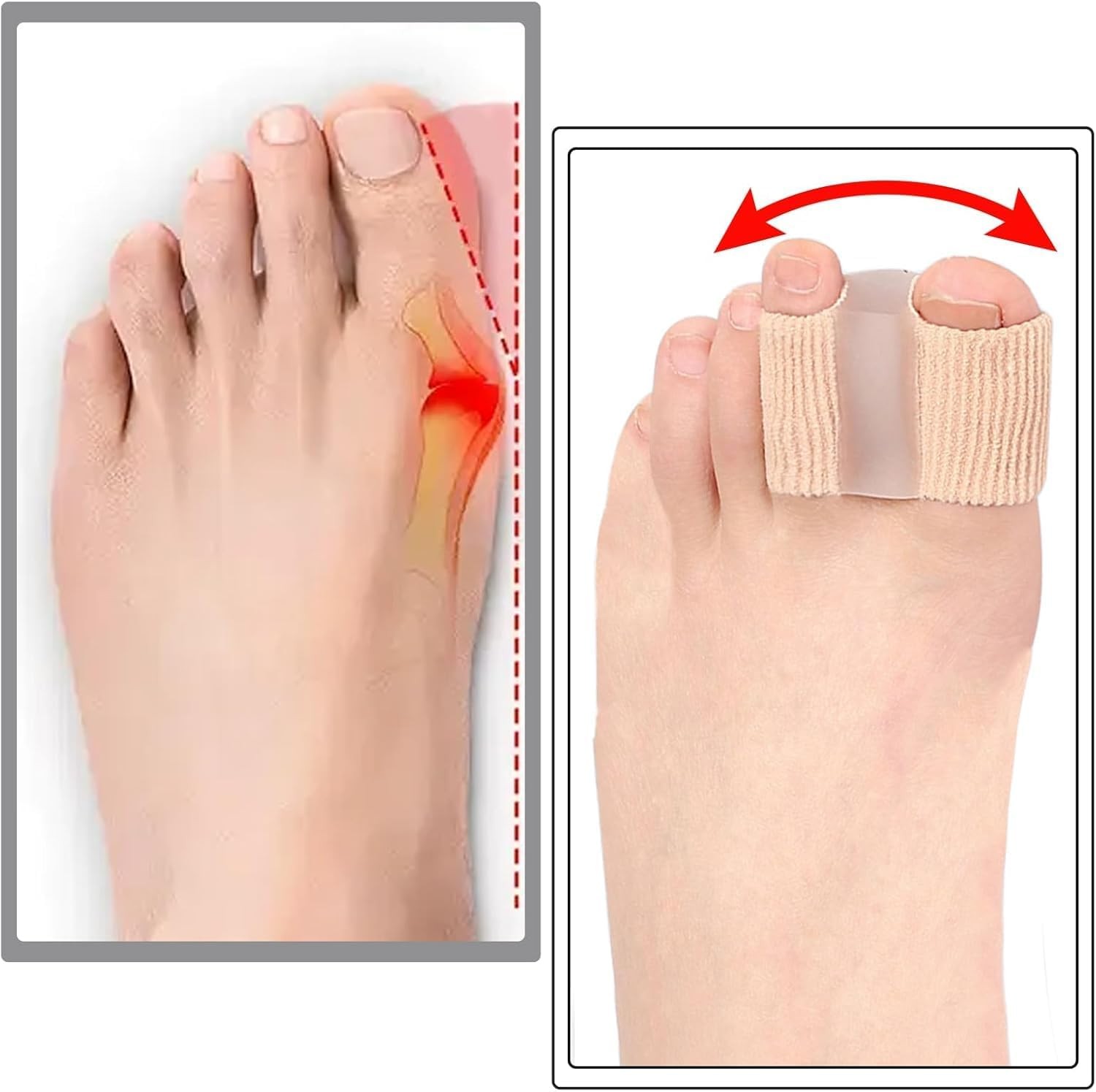 LUVINA Gel Toe Separators for Bunions & Hammer Toes – Breathable Fabric, 1L