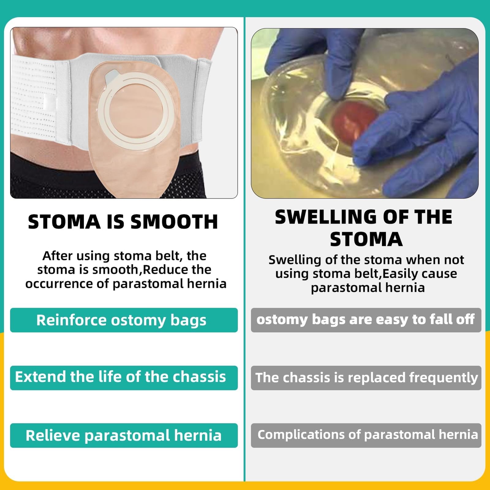 Ostomy Belt, Adjustable Stoma Support Belt, Universal Ileostomy Colostomy Bel…