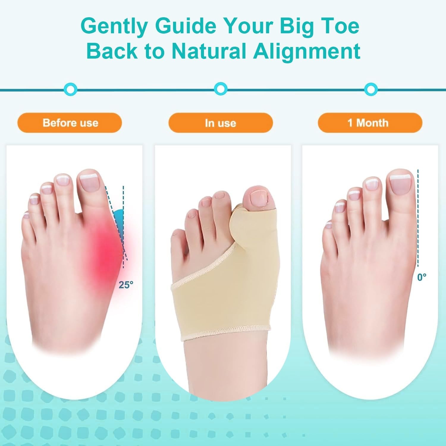 Bunion Corrector Relief Sleeves – Big Toe Straightener Gel Pads, Orthopedic Brac