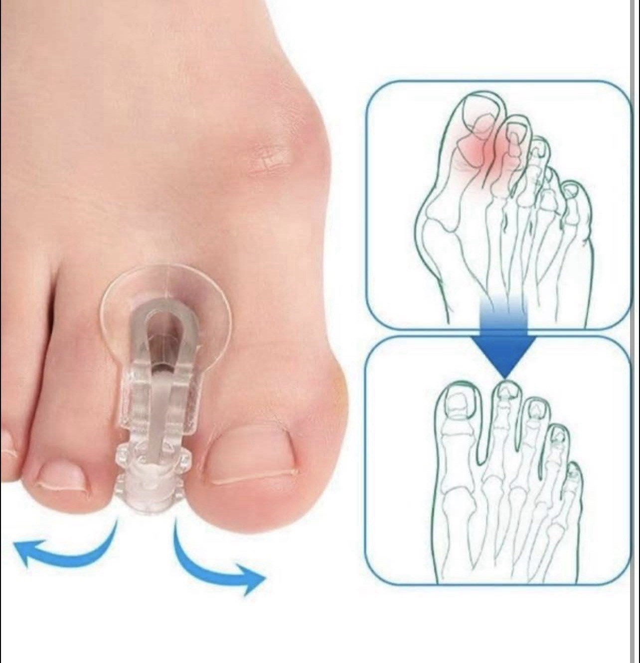Adjustable Gel Toe Separator, Clear, Bursitis, Overlapping Toes, Hammer Toe