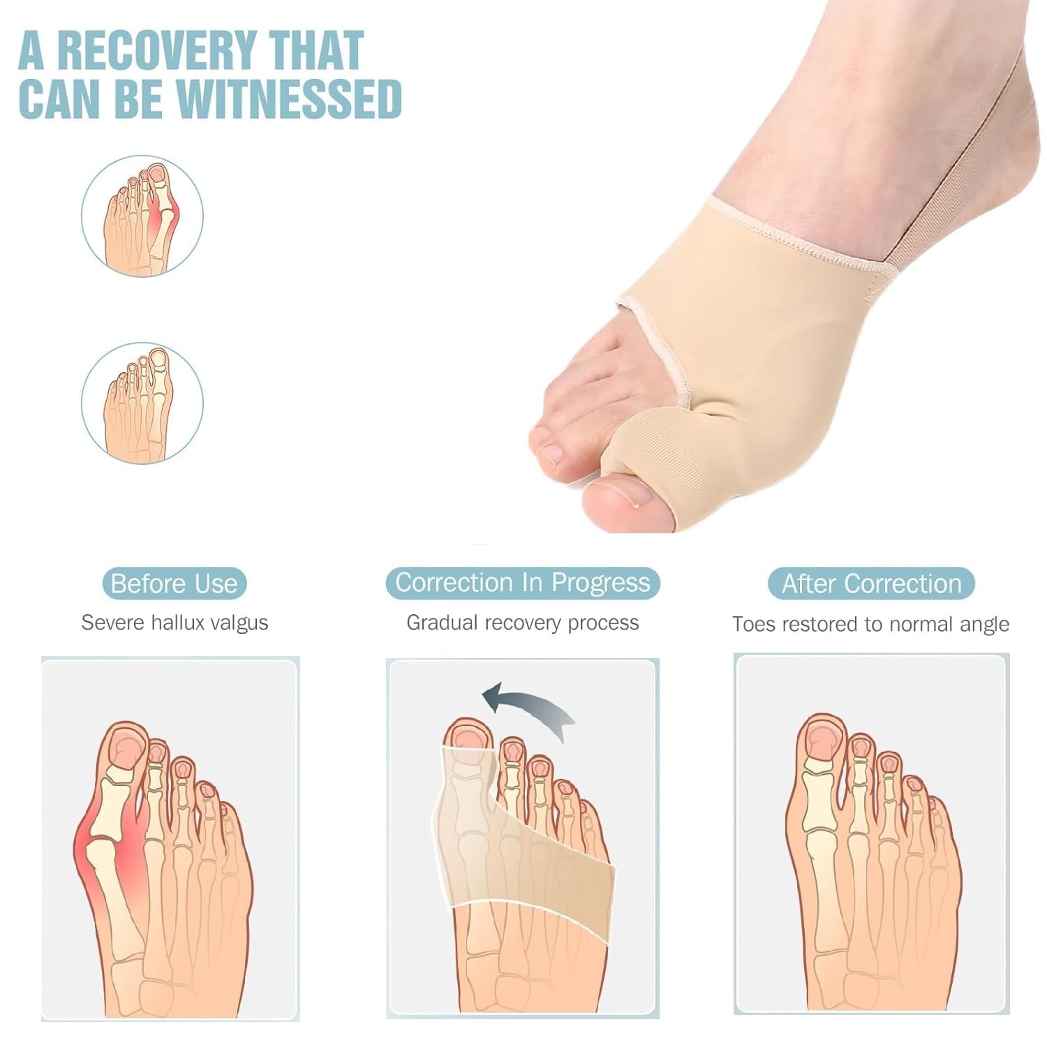 WELEQUT 2-Pack Bunion Corrector for Women & Men, Orthopedic Medium, Beige