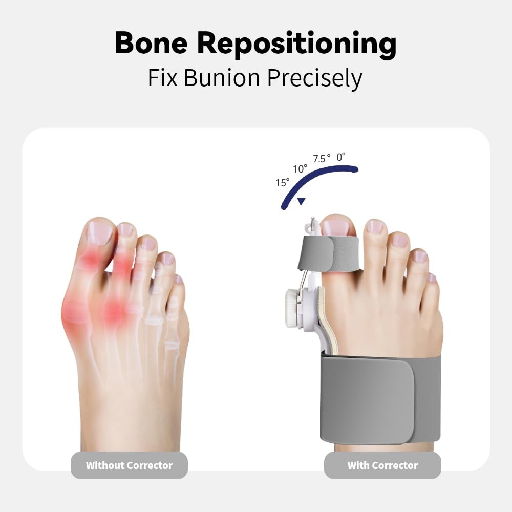 New Upgrade Treatmedy Bunion Corrector for Women & Men, Adjustable Bunion Fix Sp