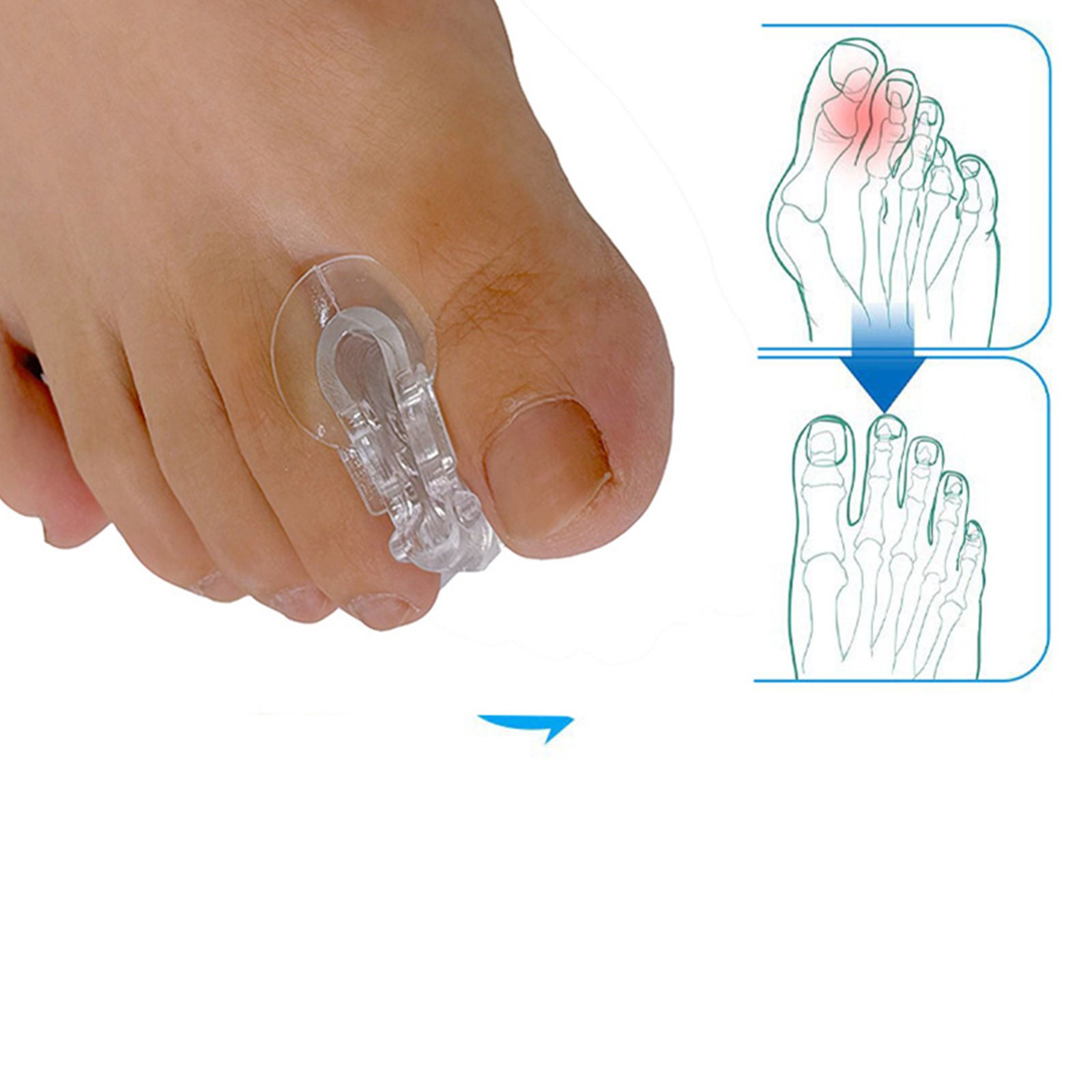 1Pair High Quality SEBS Soft Big Toe Orthotic Pad Phantom Exostosis Pain Relief