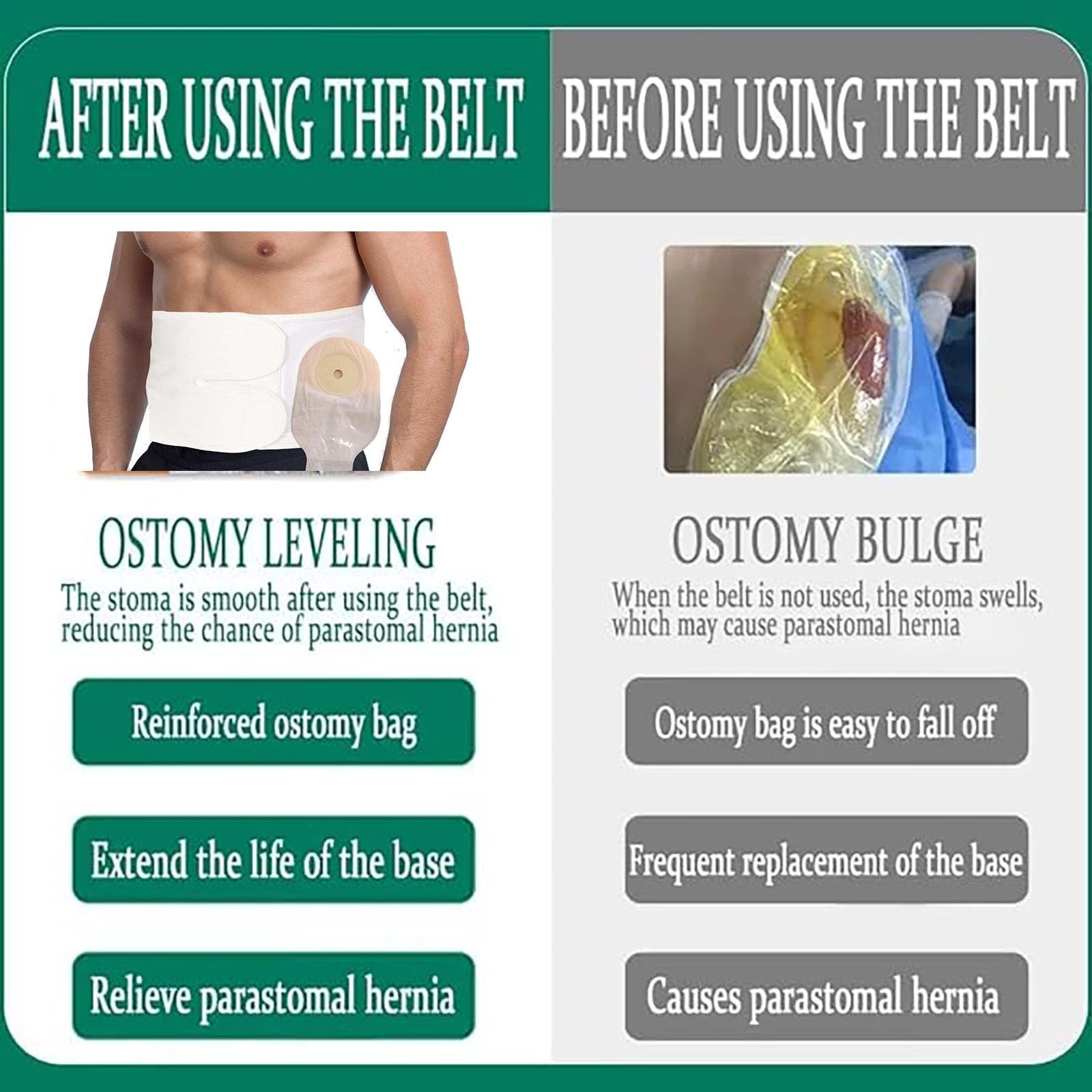 Flosmore Ostomy Support Belt，Adjustable Prevent Parastomal Hernia Support Bel…