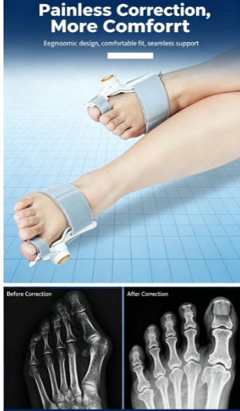 Bunion Corrector for Women & Men – Adjustable Big Toe Splint Gray-1PACK