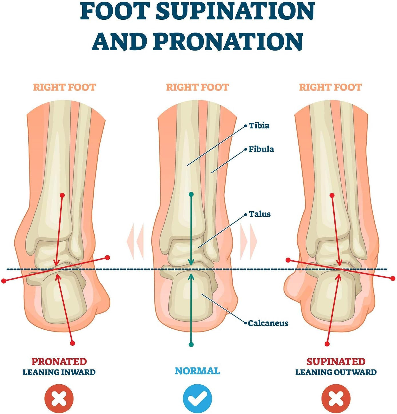 Correct | German Made Medial and Lateral Wedge Heel Straightener Insert | for Pr