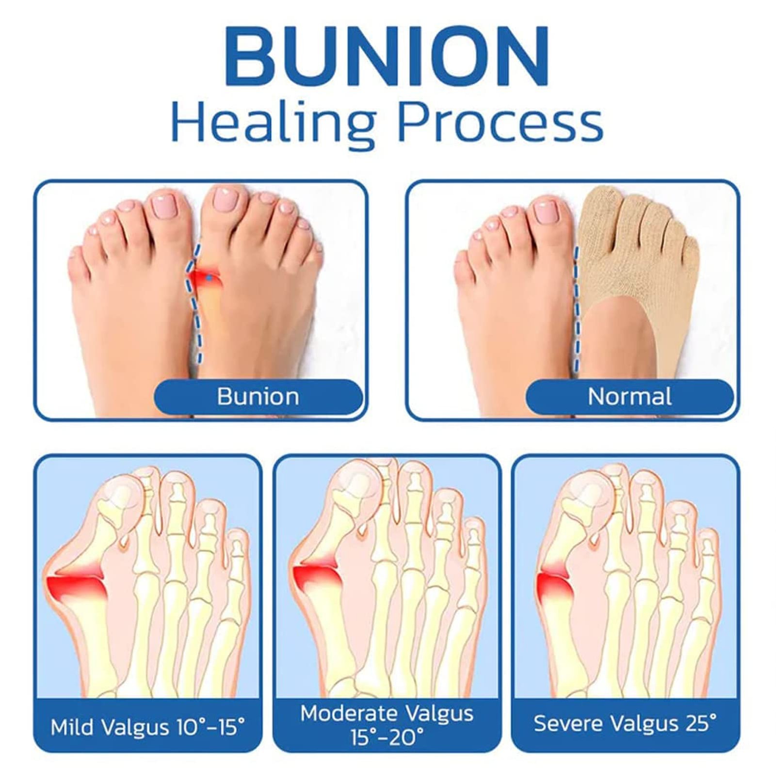 Qauxbul 5 Pairs Sock Align Toe Socks for Bunion, No One Size, Socks-B