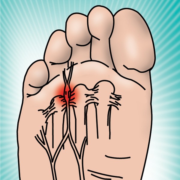 HAPAD Neuroma Pads