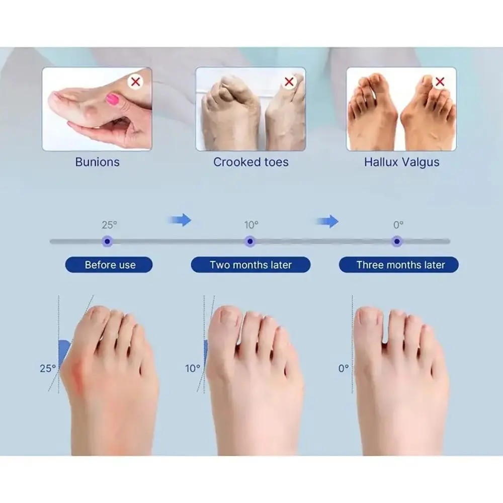 Adjustable Bunion Corrector Toe Valgus Brace Reusable Breathable Foot Support