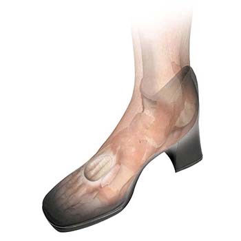 HAPAD Neuroma Pads