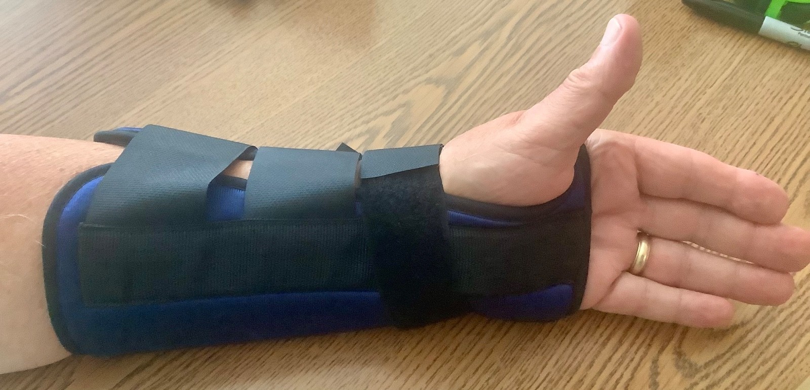 FOAM WRIST SPLINT, LEFT, LARGE, BLUE, PROCARE, STEEL IMMOBILIZATION