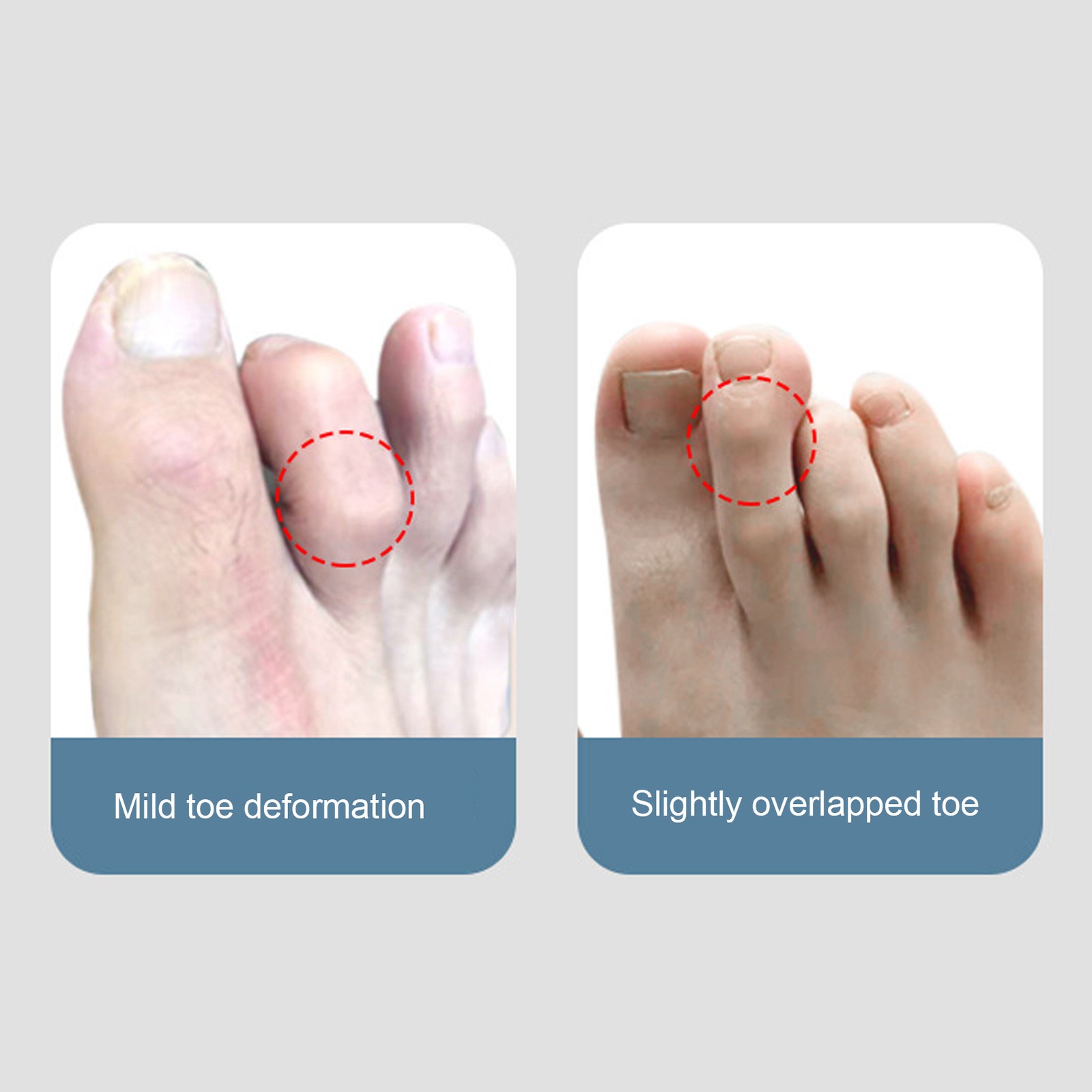 Toe Splint Skin Color Aluminum Plate Fixing Toe Brace Splint For Adult Wome OXHS