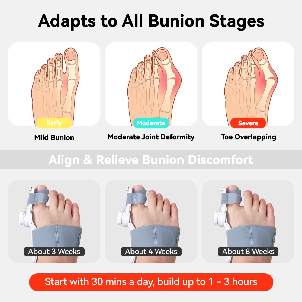 New Upgrade Treatmedy Bunion Corrector for Women & Men, Adjustable Bunion Fix Sp