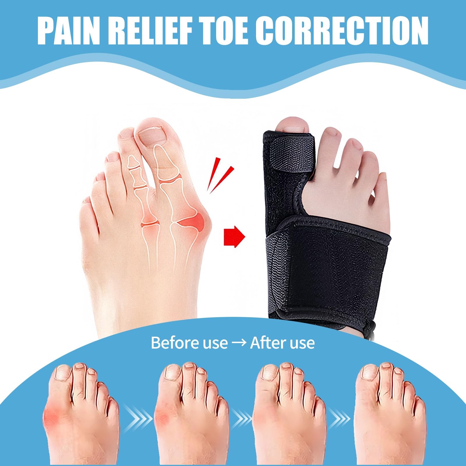 Recovist Bunion Brace for Women & Men – Corrector & Big Toe…