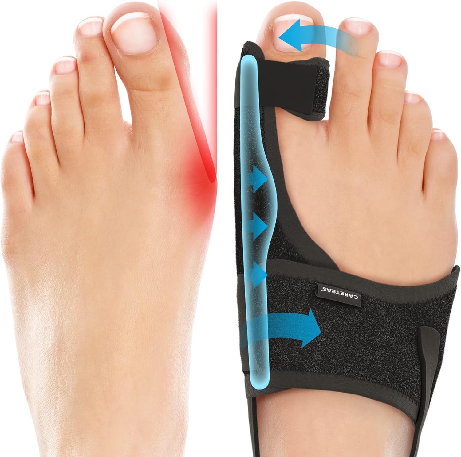Caretras 2-Pack Bunion Corrector for Women & Men, 2 Count (Pack of 1)
