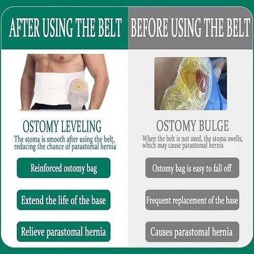 Flosmore Ostomy Support Belt，Adjustable Prevent Parastomal Hernia Support Bel…