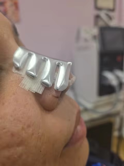 Aluminum nasal splint for Rhinoplasty Plastic After Surgery Silver Color 50pcs