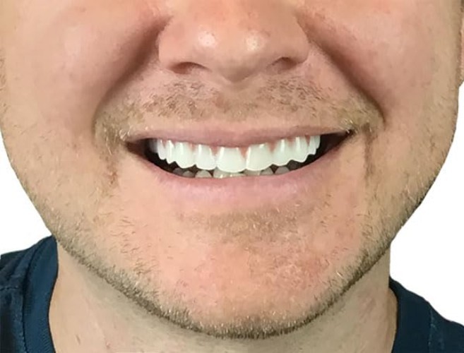 Comfort Fit Flex Natural Shade Upper Teeth Veneers for Smile Improvement