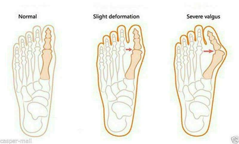 4 Pcs Gel Big Toe Bunion Guards Toe Spreaders Pain Relief Crooked Overlapping