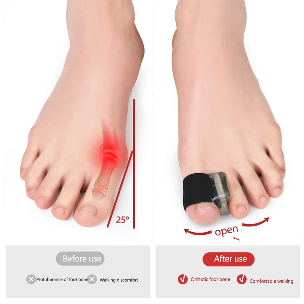 1Pair Hallux Valgus Appliance Daily Wear Silicone Foot Hallux Valgus Braces Elas