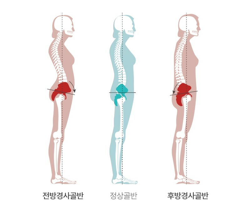 Pincher / Correct Hip Double Compression Pelvic Band