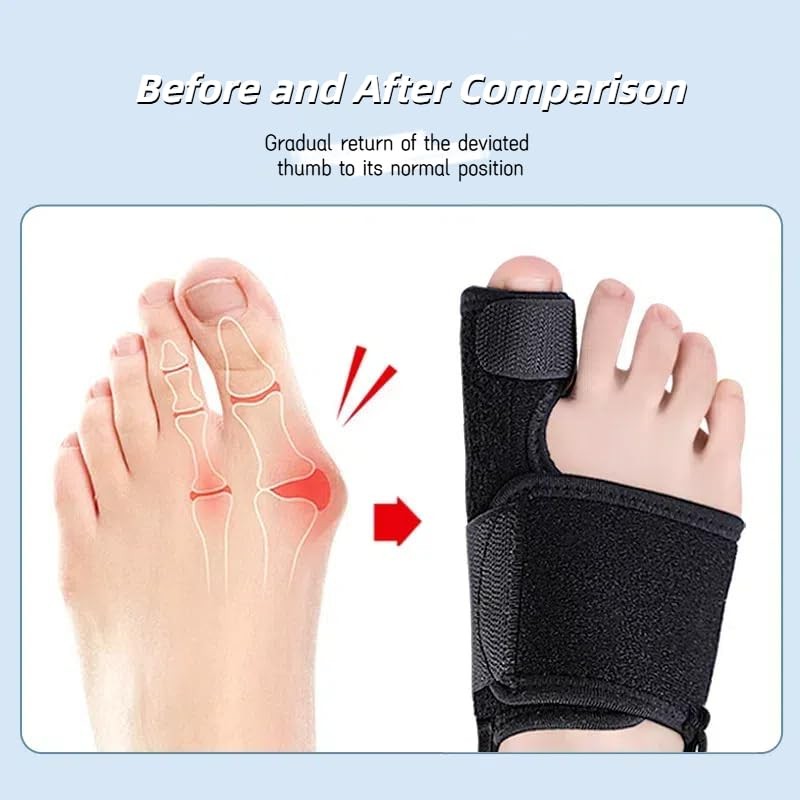 Big Toe Splint for Broken, Fracture Fixator Protectors Support for Sprains