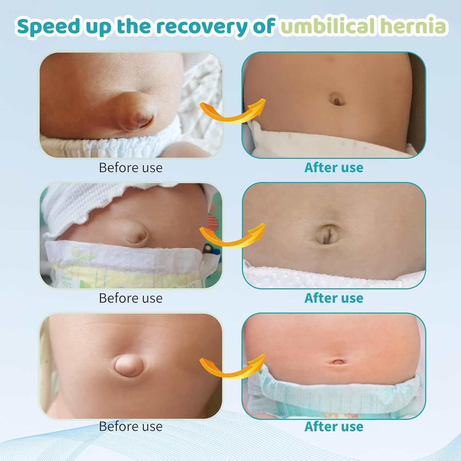 Umbilical Hernia Belt Kit for Baby with compression pads, navel patches & abdomi