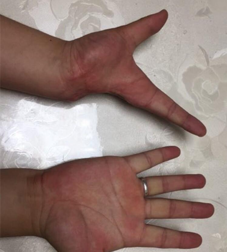 Highly Simulated Silicone Prosthesis Hand Sleeve Artificial Arm Cover Scars
