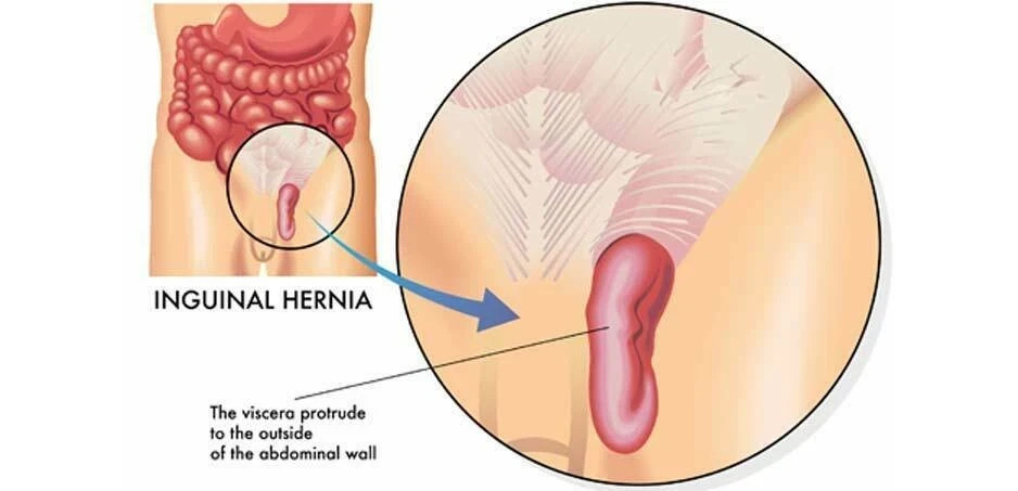 Hernia Support Belt Double Inguinal Groin Hernia Pain Relief Truss Brace For Men