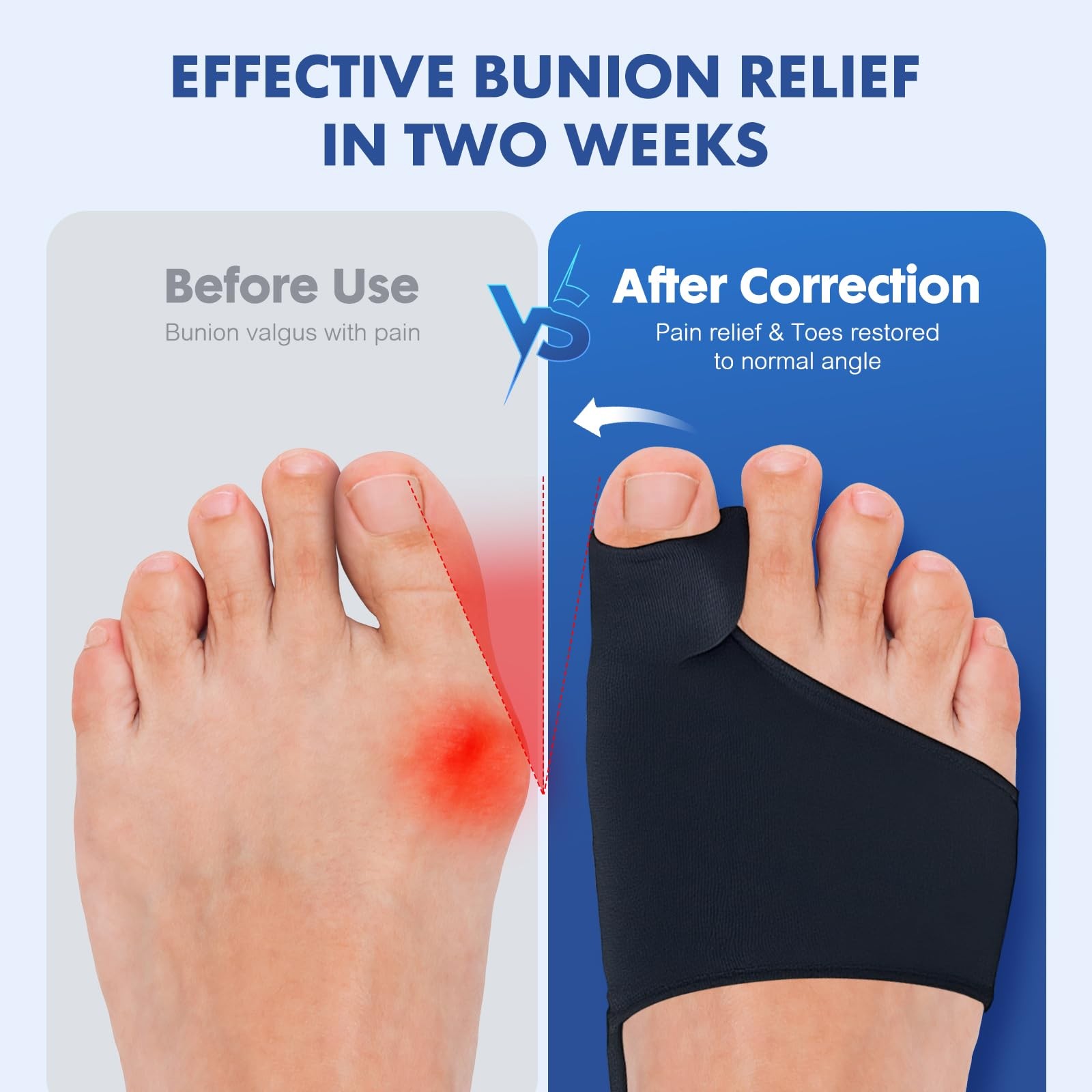 2PCS Bunion Corrector for Women & Men – Correction with Pure Black