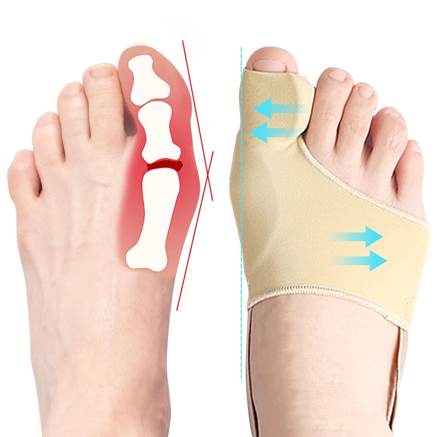 DFQ 2 Pcs Bunion Corrector Split for Women & Men Big Toe Straightener Beige NEW