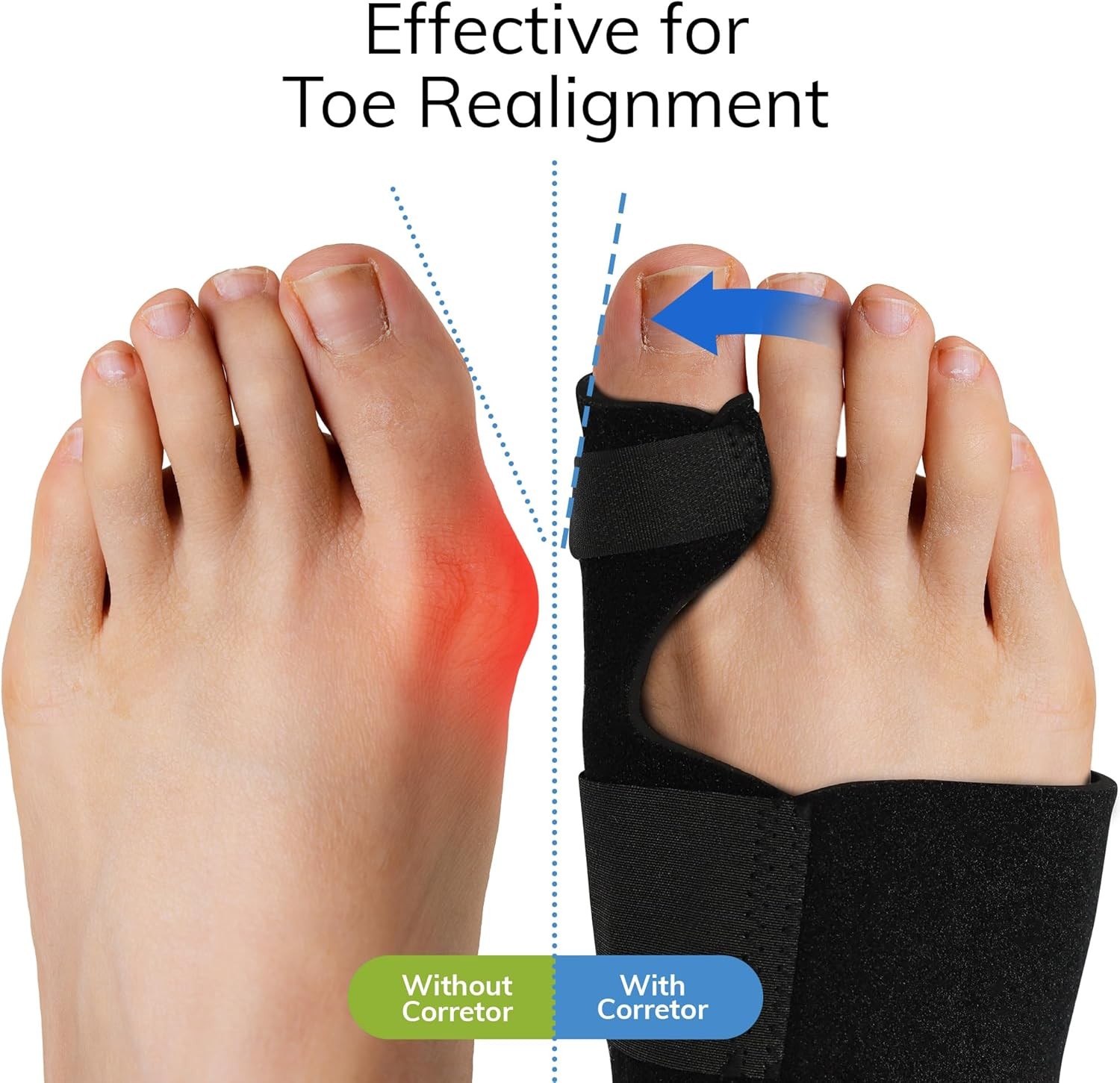 Fittest Pro Bunion Corrector (2pcs), Orthopedic Splint, Big Toe Black