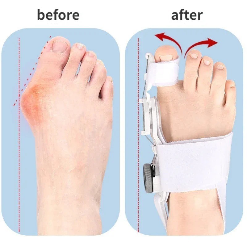 Bunion Fix Toe Valgus Corrector Adjustable Orthosis Women Men Splints