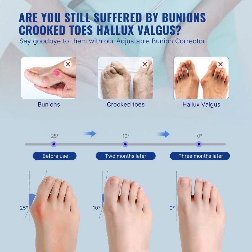 Bunion Corrector Splint Adjustable Big Toe Straightener Brace Hallux Valgus Pain