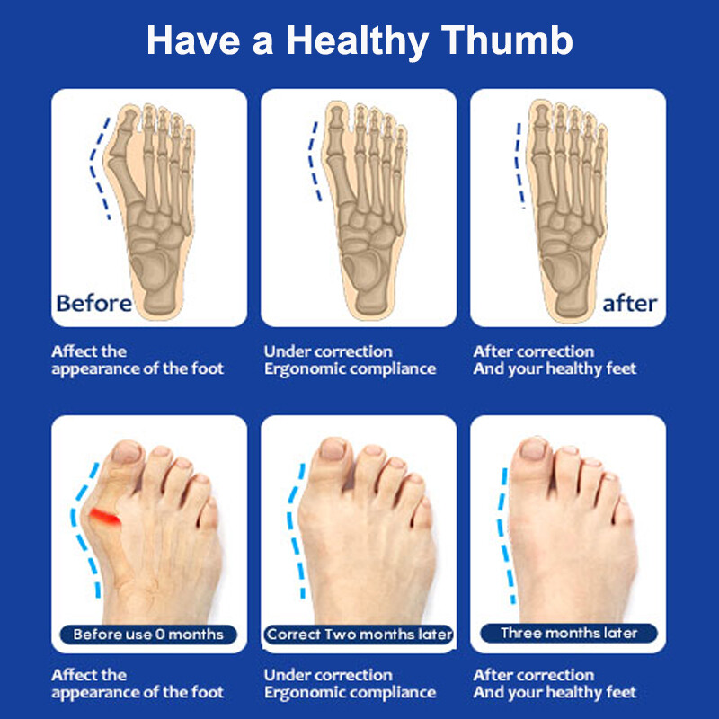 Orthopedic Big Toe Bunion Corrector Hallux Valgus Straightener Splint Support US