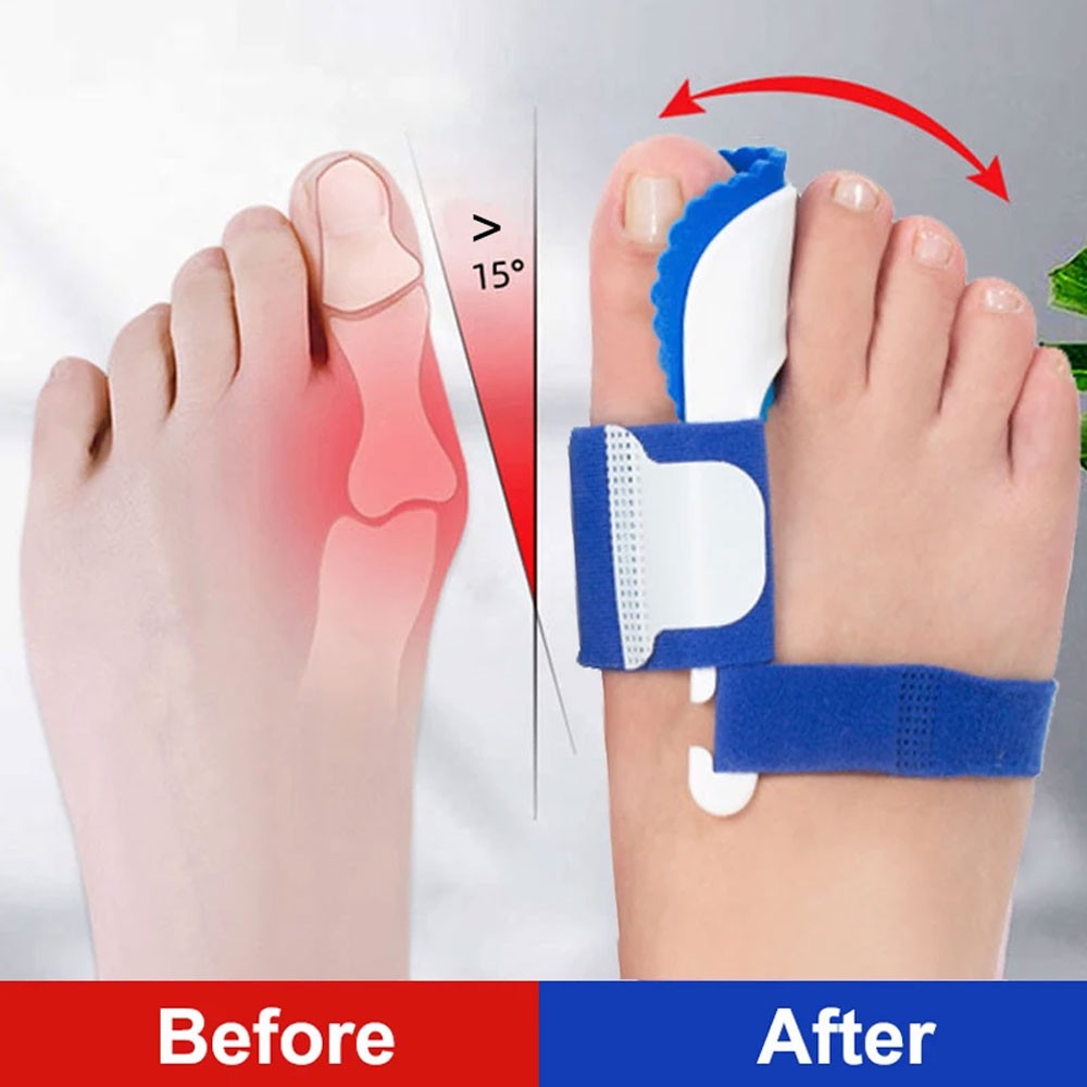 2PCS Bunion Corrector Splint Hallux Valgus Orthopedic Brace Big Toe Straightener