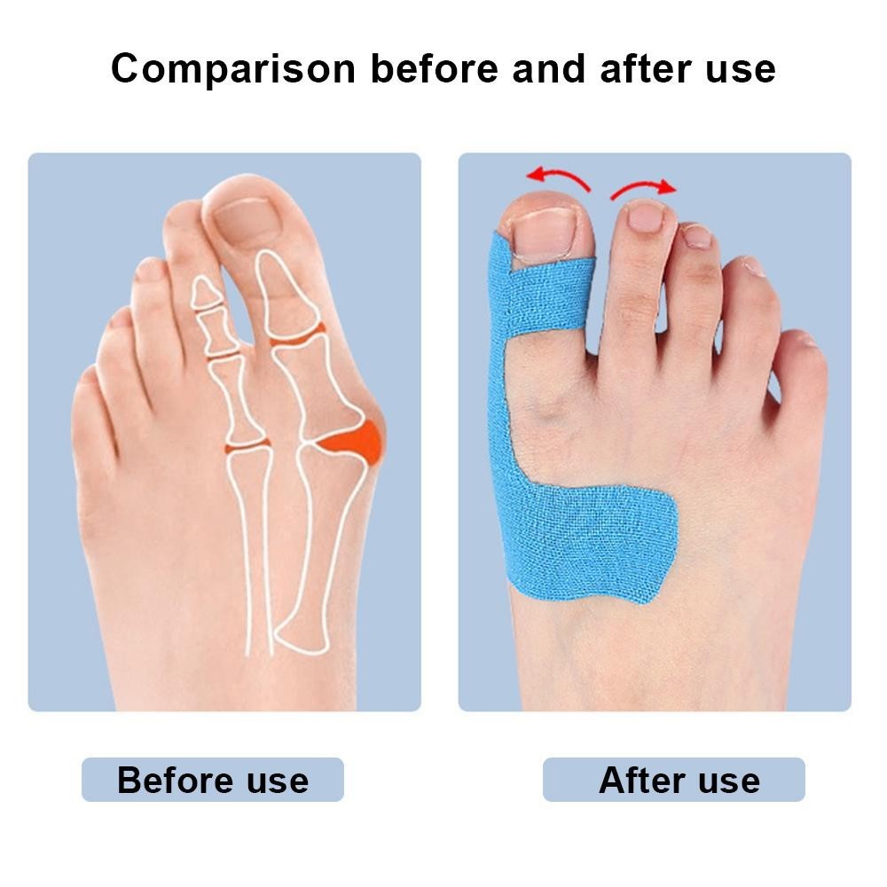 10PCS Bunion Corrector Kinesiology Tape Pain Relief Big Toe Spacer Support