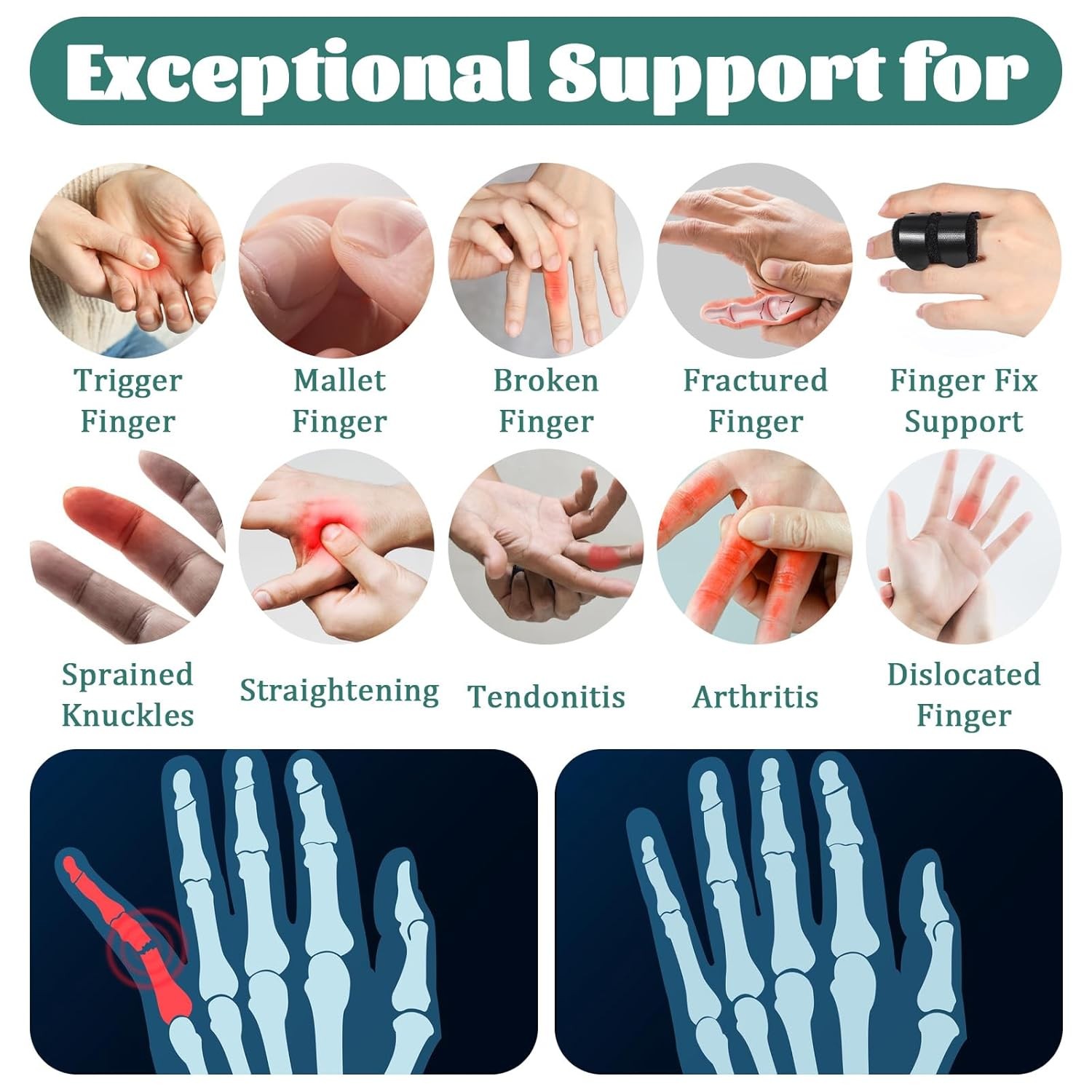 5 Pcs Trigger Thumb Splints, Finger Brace for Straightening or Support
