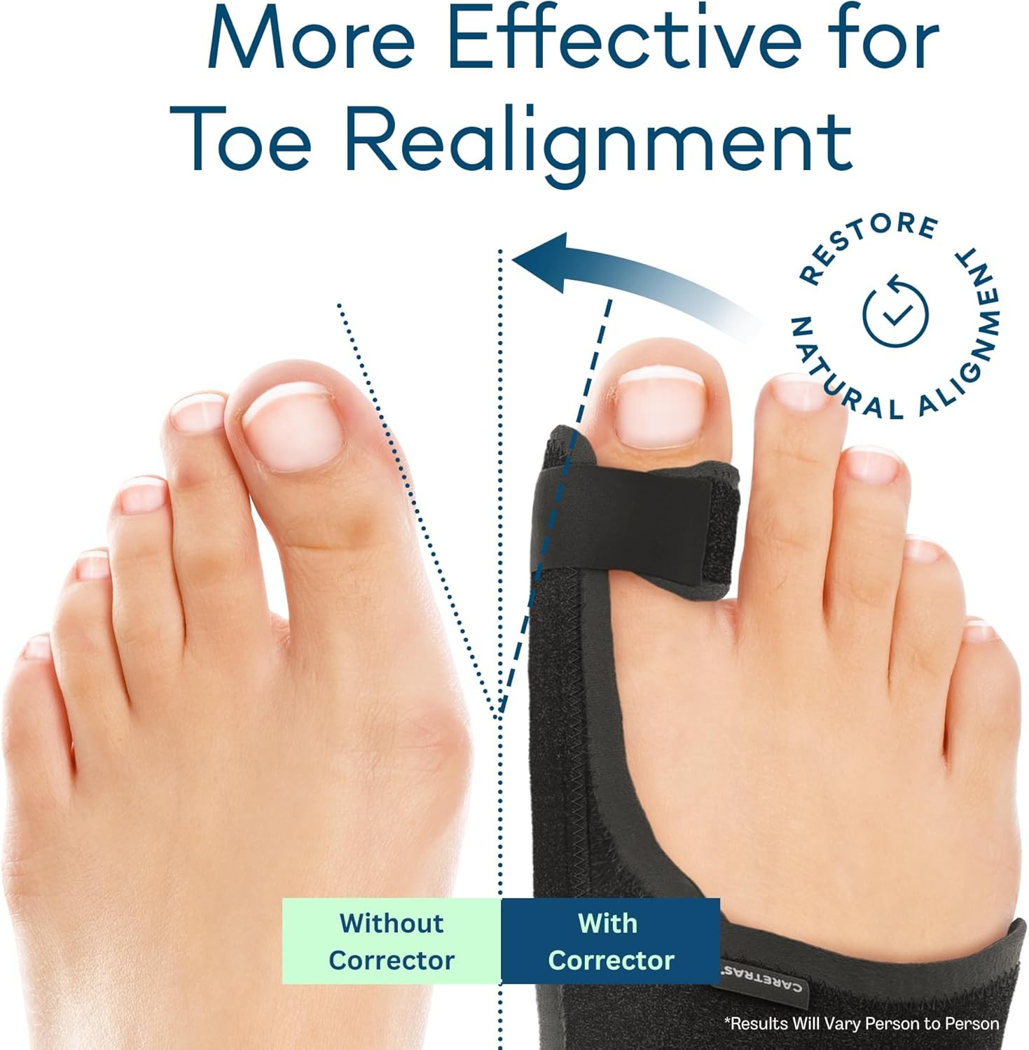 Caretras 2-Pack Bunion Corrector for Women & Men, 2 Count (Pack of 1)