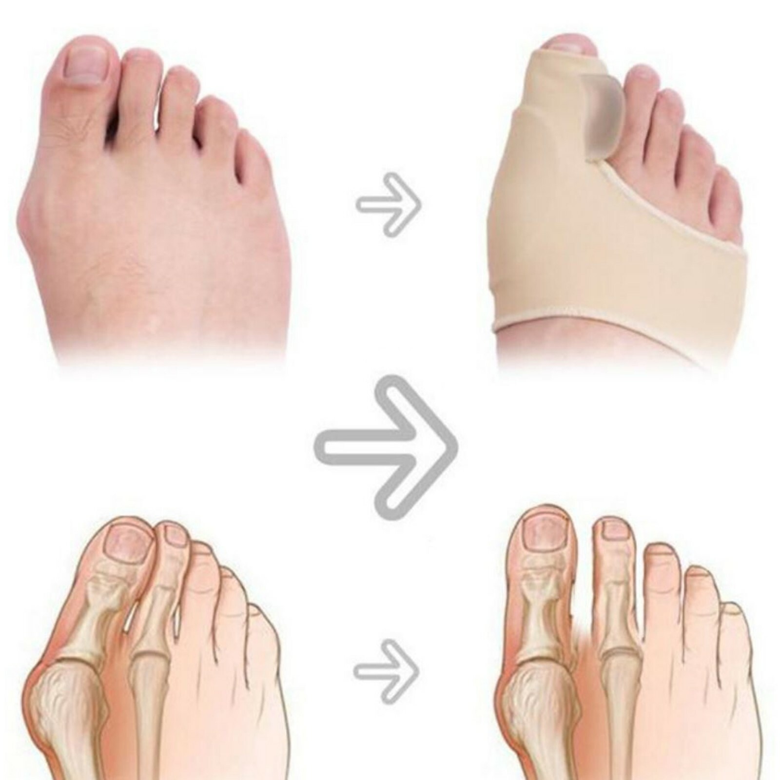 AdorePro Big Toe Separator Bunion Corrector Splint Straightener Foot Pain Relief