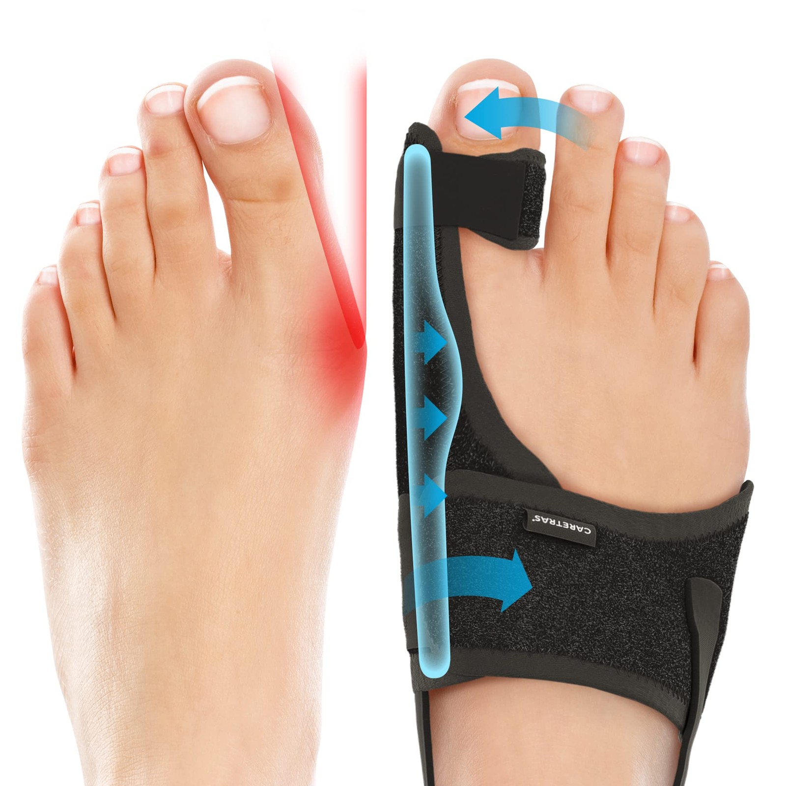 Caretras 2-Pack Bunion Corrector for Women & Men, 2 Count (Pack of 1), Black