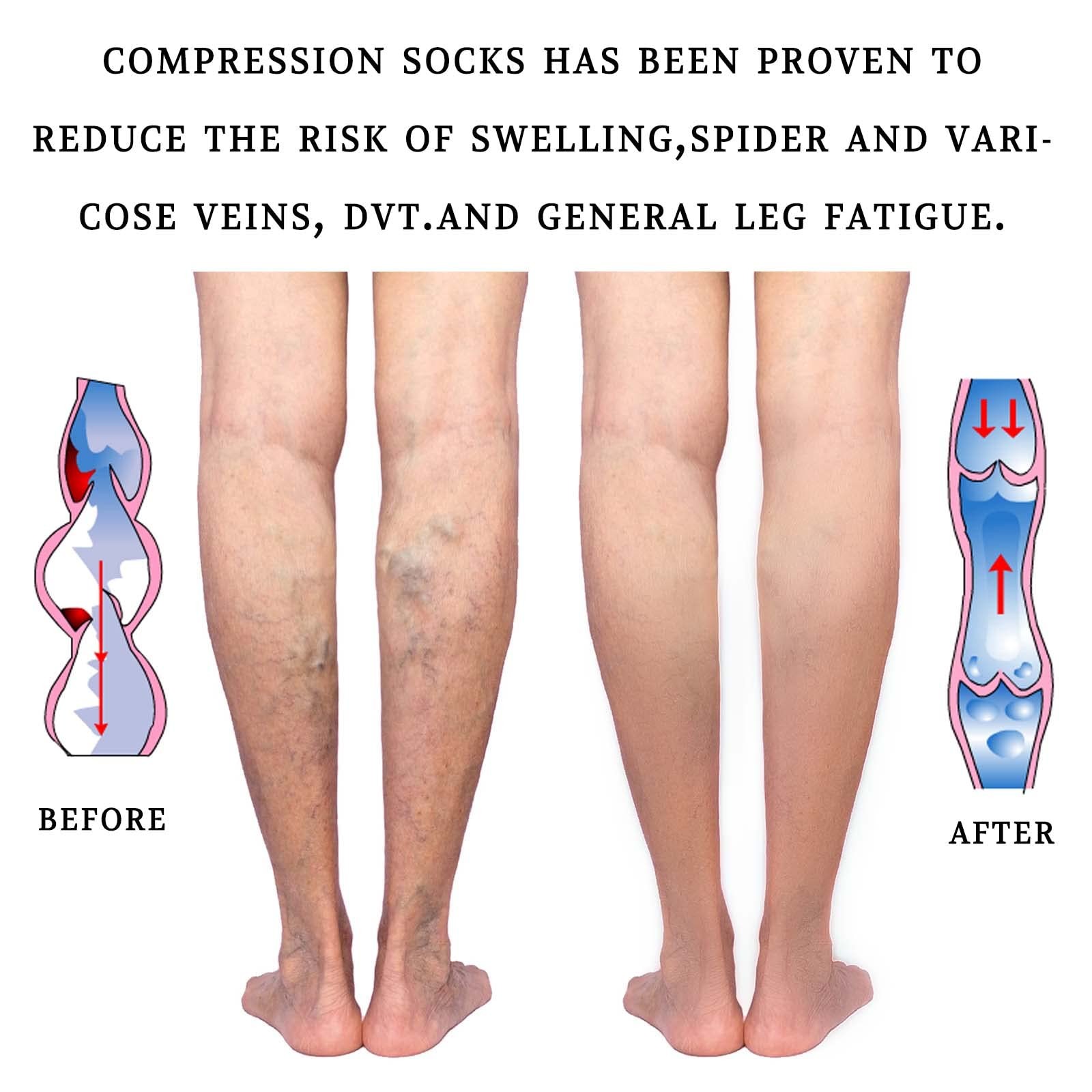 15-20 mmHg Medical Compression Stockings for Women and Men Thigh High Dot-Top…