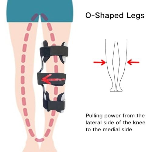 Kids Leg Posture Corrector Brace – O/X Legs Type Straightener for Bow Legs & Val